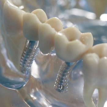 Implantate schützen vor Knochenrückbildung und geben dem Zahnersatz festen Halt